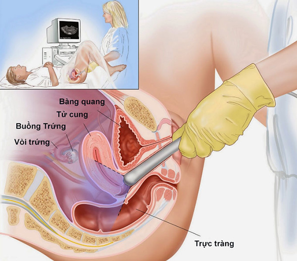 sieu-am-voi-trung Siêu âm vòi trứng