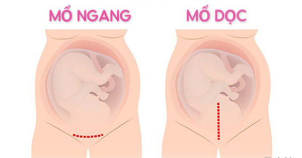 sinh-mo-lan-2-lan-3-sinh-thuong-duoc-khong Sinh mổ 2 lần lần 3 có sinh thường được không