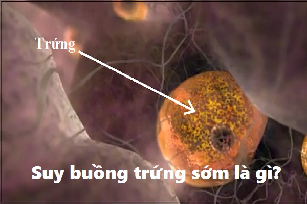 Suy buồng trứng sớm