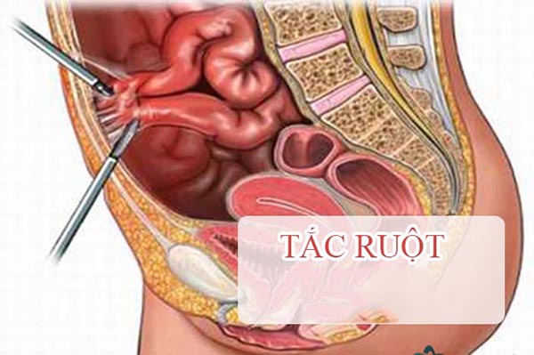 tac-ruot Tắc ruột