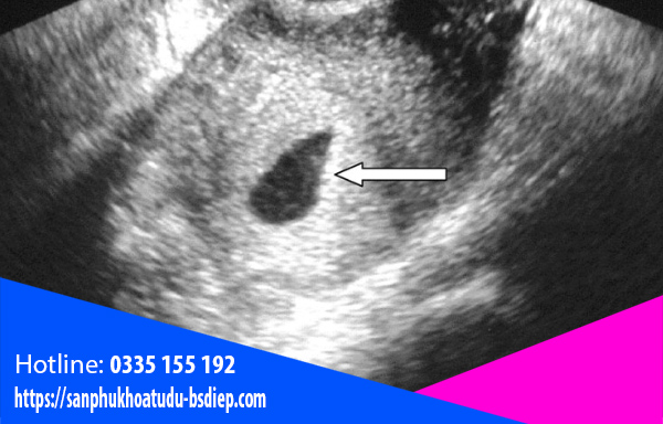 Thai ngoài tử cung siêu âm có thấy không