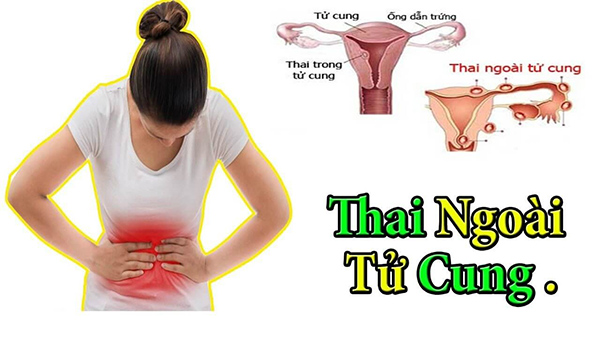 Thai ngoài tử cung thử que hai vạch không