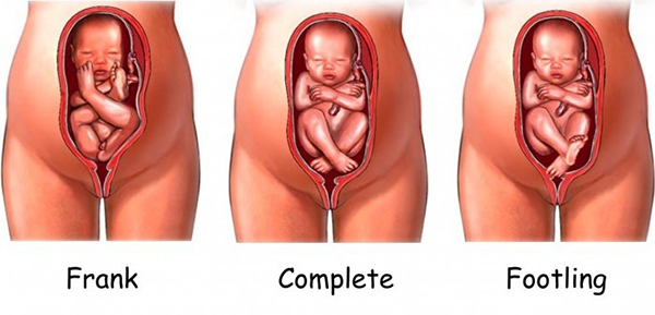 Các kiểu thai ngôi mông