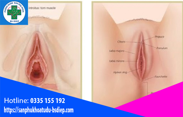 Thu hẹp âm đạo