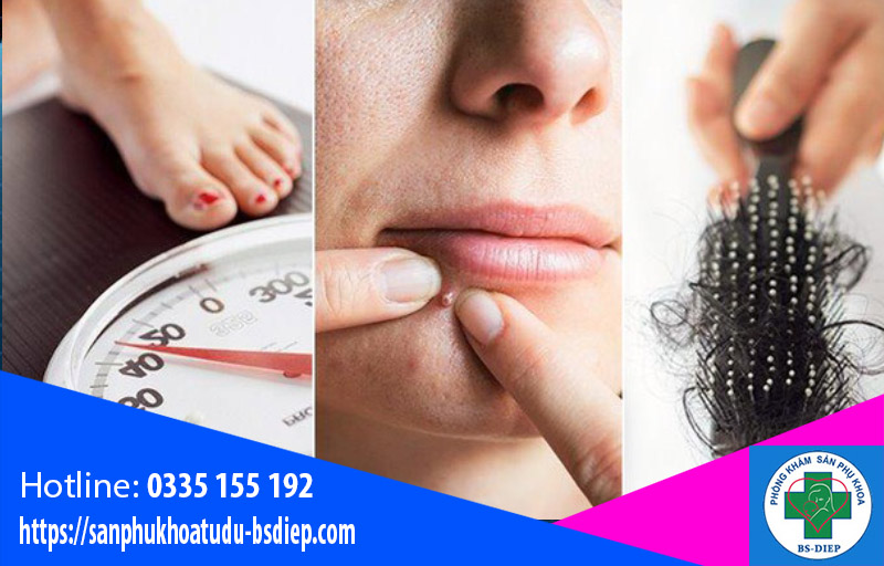 Triệu chứng buồng trứng đa nang