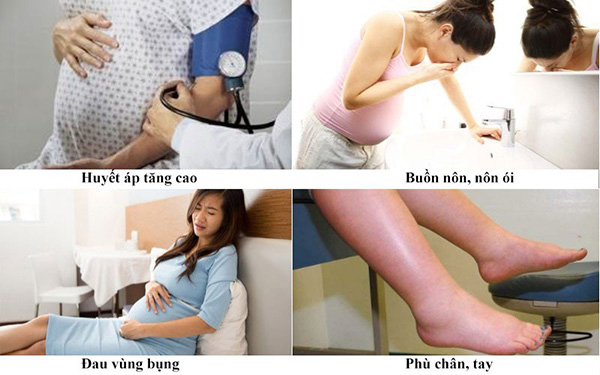 trieu-chung-tien-san-giat1 Triệu chứng tiền sản giật