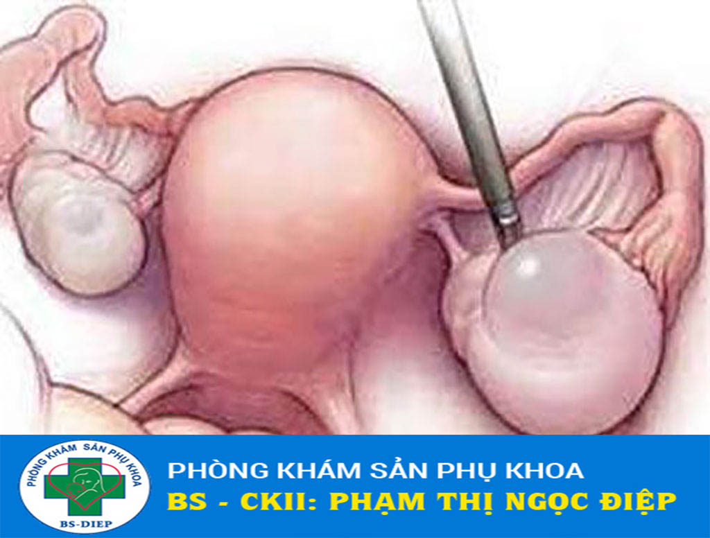 U nang buồng trứng có nguy hiểm không