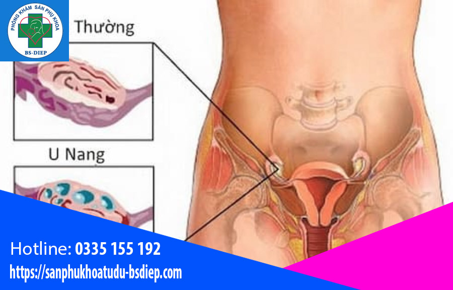 U nang buồng trứng nguy hiểm không
