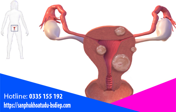 U xơ cổ tử cung