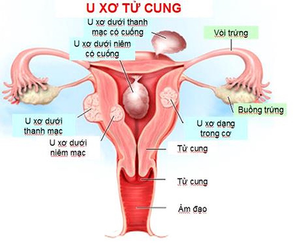 u-xo-tu-cung U xơ tử cung
