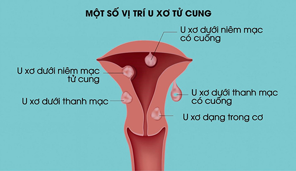 Vị trí nhân xơ tử cung